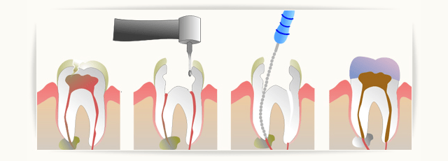 stomatologija-davidovic-endodoncija-header