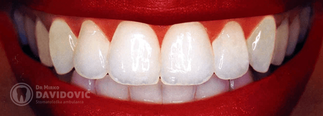 stomatologija-davidovic-izbjeljivanje-zuba-header